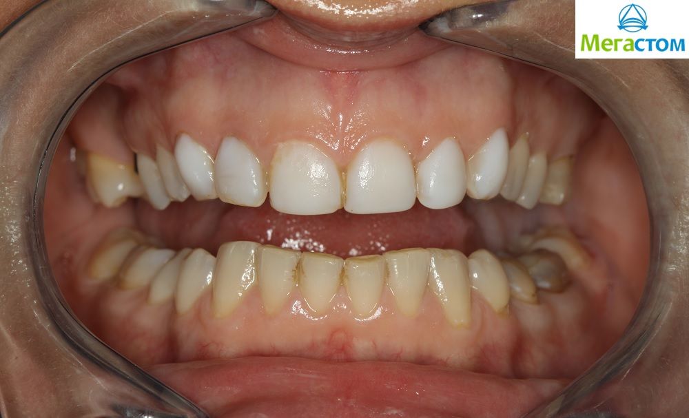 Зубы перед установкой виниров фото