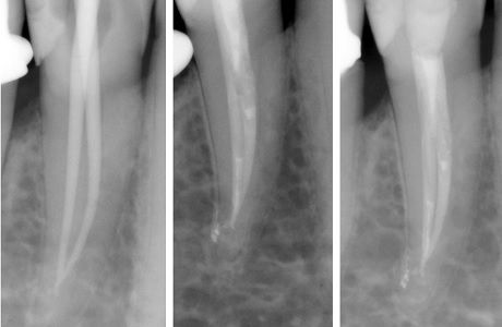 Лечение пульпита зуба с двумя корневыми каналами и дельтовидным разветвлением у верхушки корней