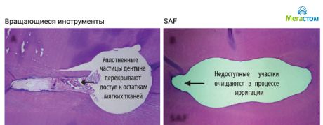 эндодонтическая система SAF в лечении корневых каналов