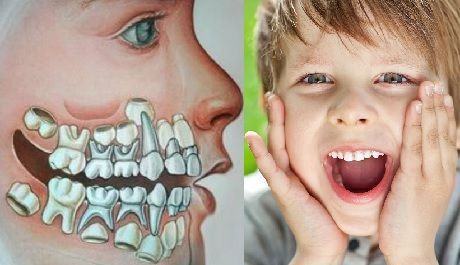 исправление прикуса без брекетов у детей, процедура лечения кариеса у ребенка, пломбирование передних зубов у ребенка