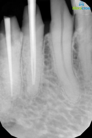 Пломбирование каналов зубов гуттаперчей, корневой кариес лечение