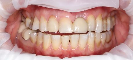 лечение зуба и установка коронки, технология установки коронки на зуб этапы 