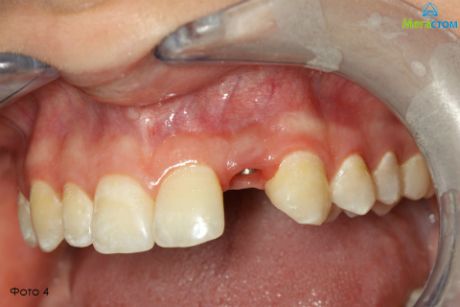 извлечен формирователь десны, варианты протезирования зубов при отсутствии одного