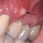 киста зуба в гайморовой пазухе лечение