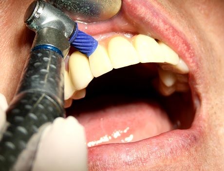 Индивидуальная и профессиональная гигиена полости рта, имплант наращивание костной ткани