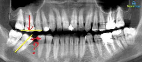 Создание условий для дентальной имплантации, через сколько ставят имплант после удаления зуба