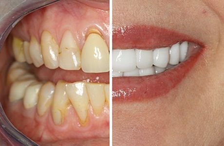 Косметическая реставрация зубов из диоксида циркония