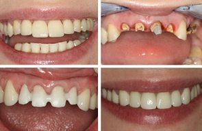 Безметалловые художественные реставрации на все зубы