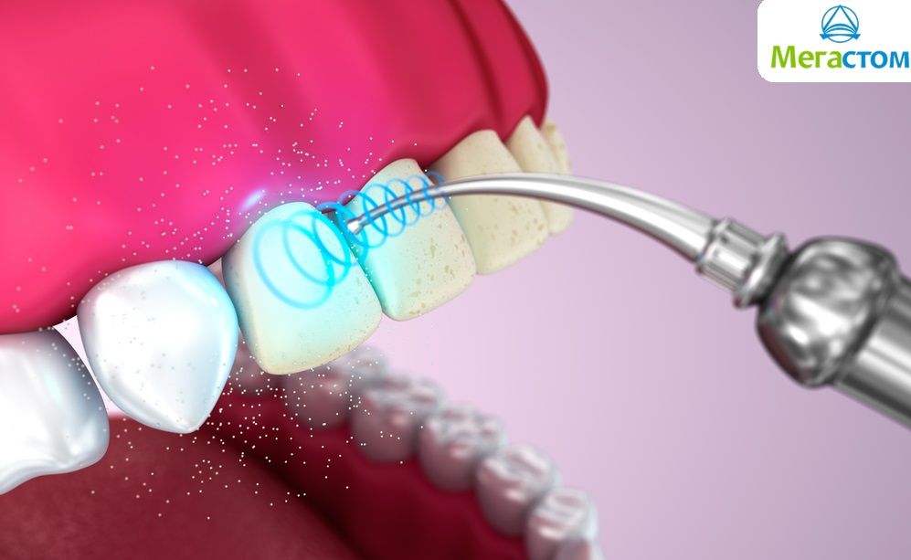Безопасна ли ультразвуковая чистка зубов?