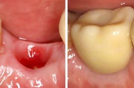 Современный подход к восстановлению отсутствующего зуба: второй этап