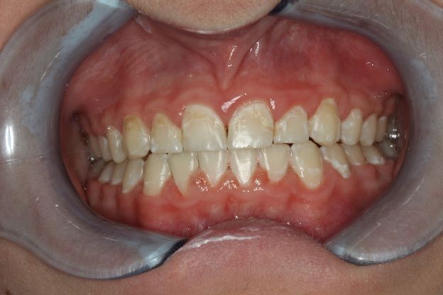 Минерализация зубов и для чего она нужна?