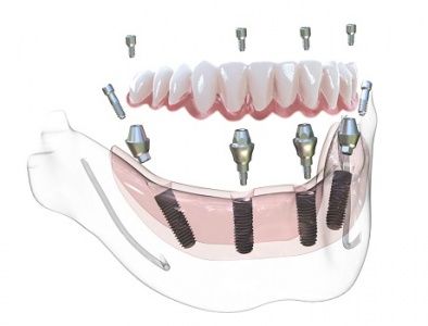 Имплантация зубов All-on-4
