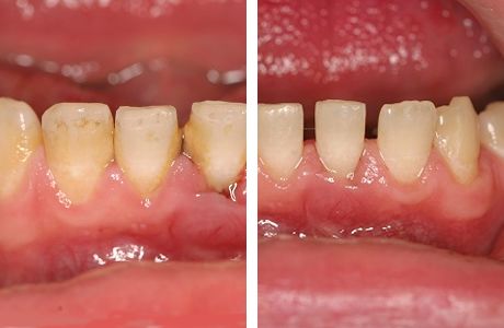 Болезненность зубов после профессиональной гигиены полости рта