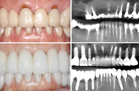 Комплексное лечение в зубочелюстной области  и восстановление эстетики улыбки