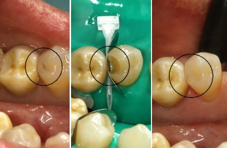 Лечение скрытого среднего кариеса 17 зуба 
