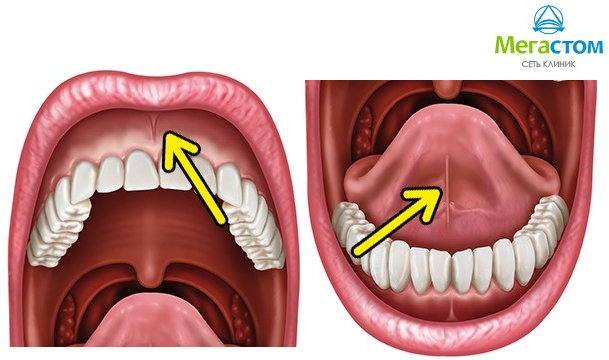  Пластика уздечки губ и языка