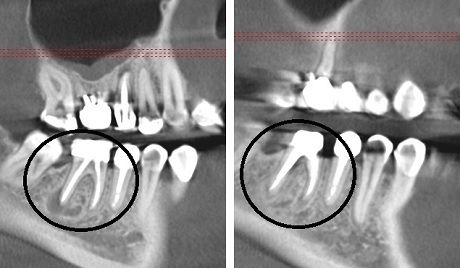 Лечение хронического периодонтита 36-го зуба и корневой кисты