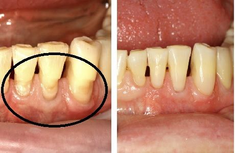 Лечение клиновидного дефекта на передних зубах