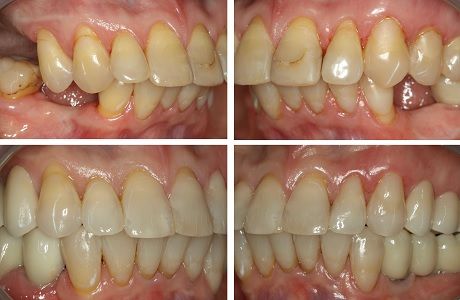 Комплексное лечение пациента с неправильным прикусом и отсутствием большого количества зубов