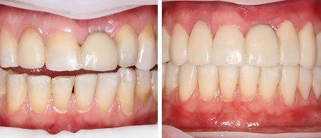 Первый этап лечения дисфункции ВНЧС, стираемости зубов и восстановления эстетики улыбки 