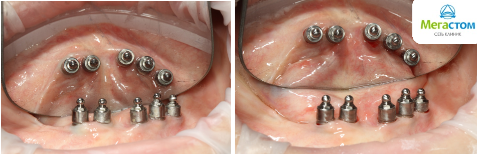 До и после профессиональной гигиены полости рта со съемными протезами на имплантатах