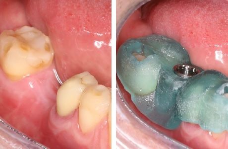 Современный подход к восстановлению отсутствующего зуба
