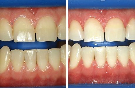 Клиническое отбеливание зубов системой «ZOOM AP»