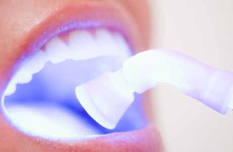 Что такое лазерное отбеливание зубов?