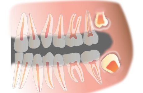 Зубы мудрости – лечить или удалять?
