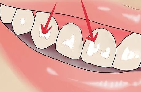 Что делать, если появился флюороз на зубах?