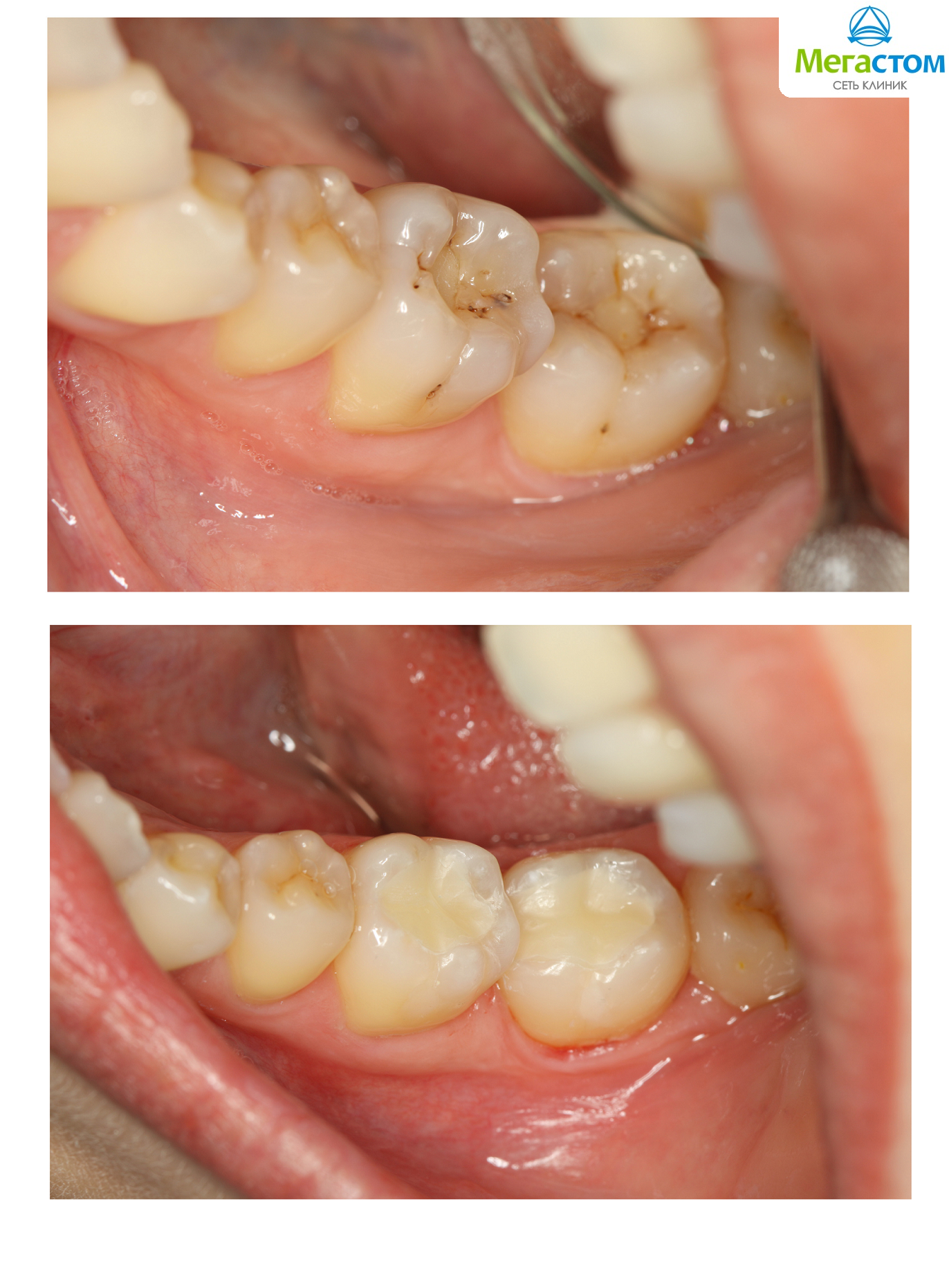 До и после пломбирования зубов
