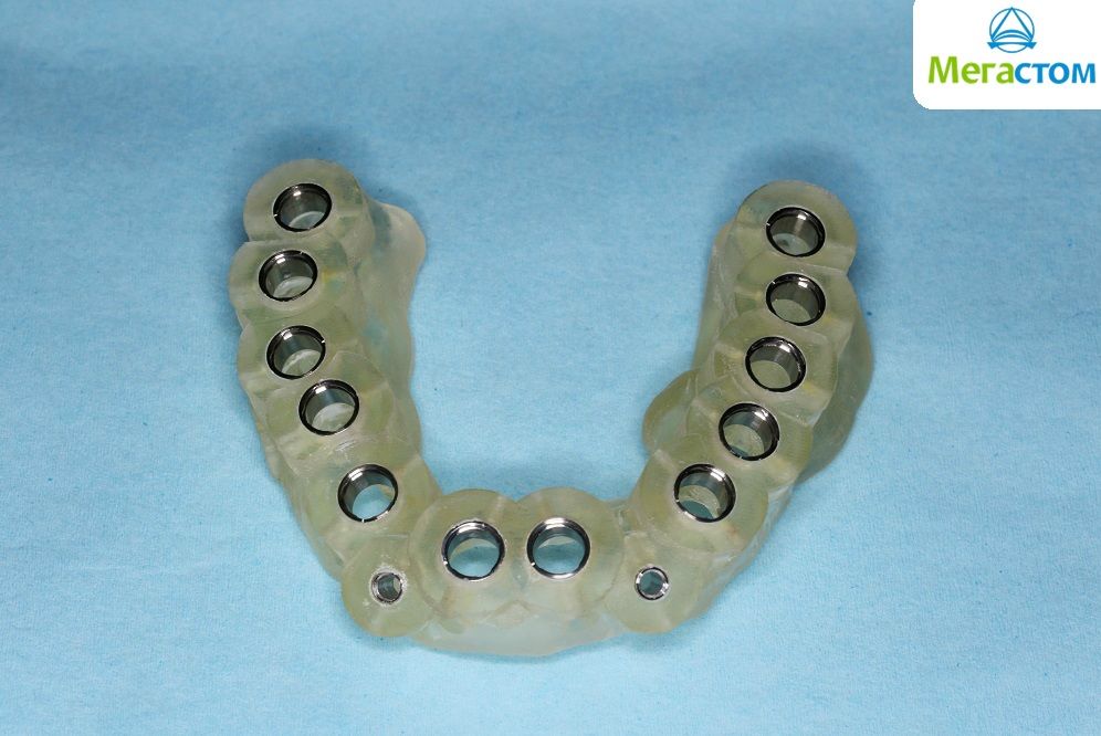3D-хирургические шаблоны для имплантации зубов
