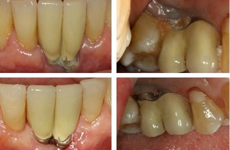 Снятие плотных зубных отложений в полости рта с реставрациями