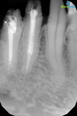 Контрольный снимок запломбированных корневых каналов, пломбирование каналов болит зуб