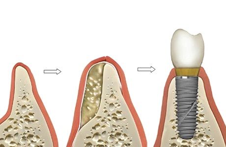 этапы имплантации зубов с наращиванием костной ткани