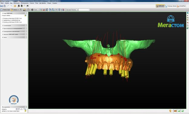 3D-моделирование имплантации, установка коронок на импланты