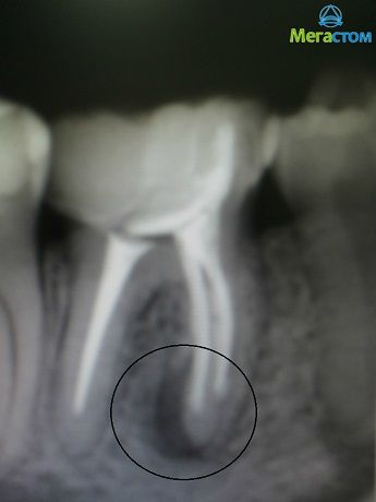 сколько может болеть зуб после пломбирования каналов