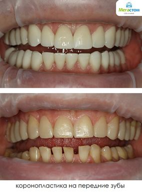 Коронопластика на передние зубы