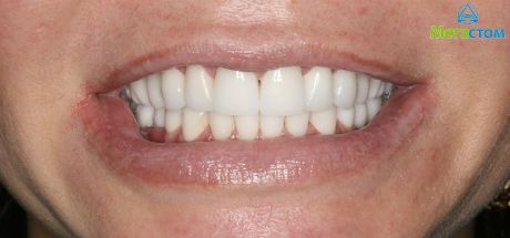 установка импланта сразу после удаления зуба, можно ли ставить имплант после удаления зуба