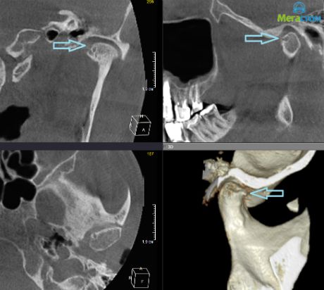 3D-компьютерная рентгендиагностика при заболеваниях ВНЧС, стоматология установка коронки 