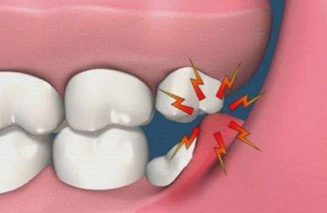 лечение кариеса постоянных зубов