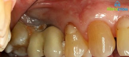 До лечения, протезирование зубов на имплантах стоимость 