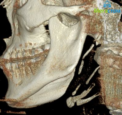 3D-компьютерная рентгендиагностика при заболеваниях ВНЧС, цена протезирования зубов полностью всю челюсть 