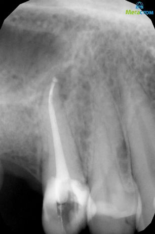 Сложная анатомия корневых каналов, может ли болеть зуб после пломбирования канала