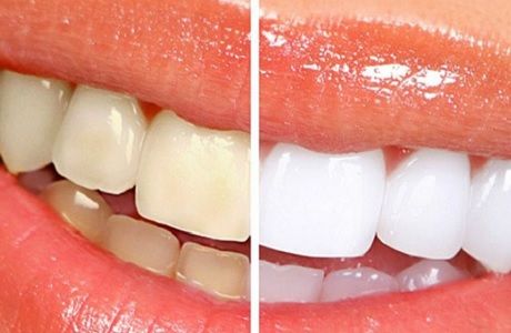 лазерное отбеливание зубов до и после