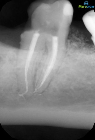 Сложная анатомия корневых каналов, пломбирование каналов зуба больно или нет