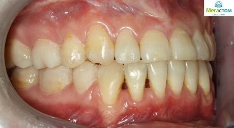 Ортодонтическое лечение комбинированное с ортогнатической коррекцией прикуса