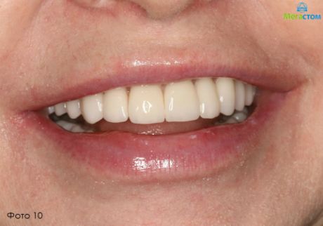 Виниры и коронки, зафиксированные на живые зубы, протезирование передних зубов цена 