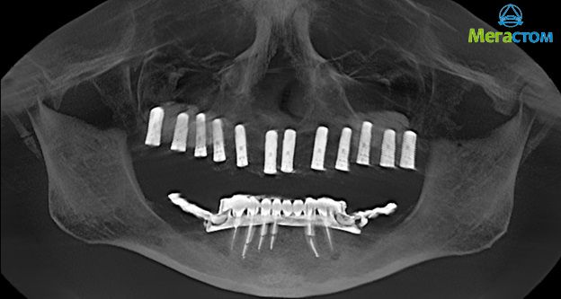 имплантация зубов, кт для имплантации зубов цена в москве