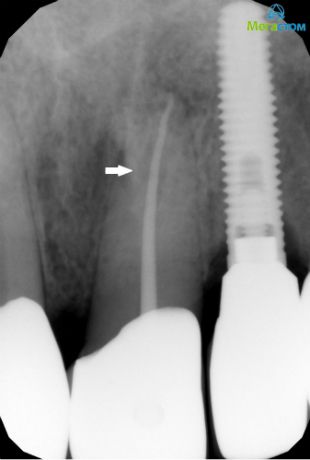 Определено колбовидное расширение корневого канала зуба 2.1 